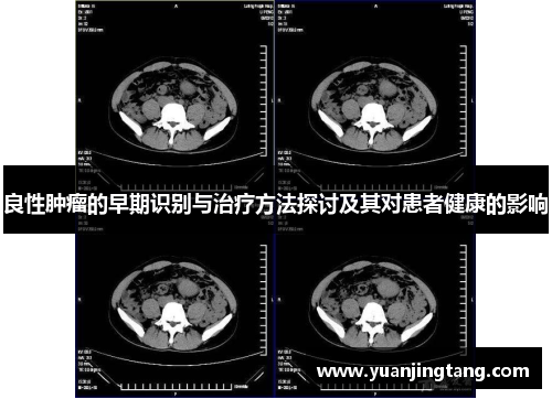 良性肿瘤的早期识别与治疗方法探讨及其对患者健康的影响